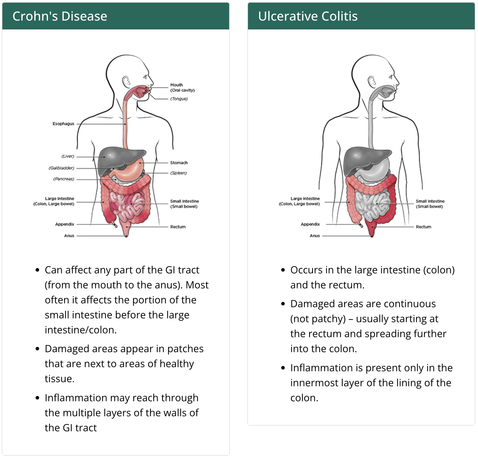 A side-by-side chart comparison of the 2 types of inflammatory bowel disease: crohn's disease and ulcerative colitis