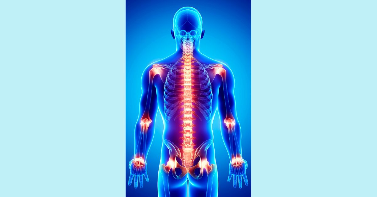 A glowing, blue-toned x-ray photo of a human with bright red inflamed areas along spine and joints